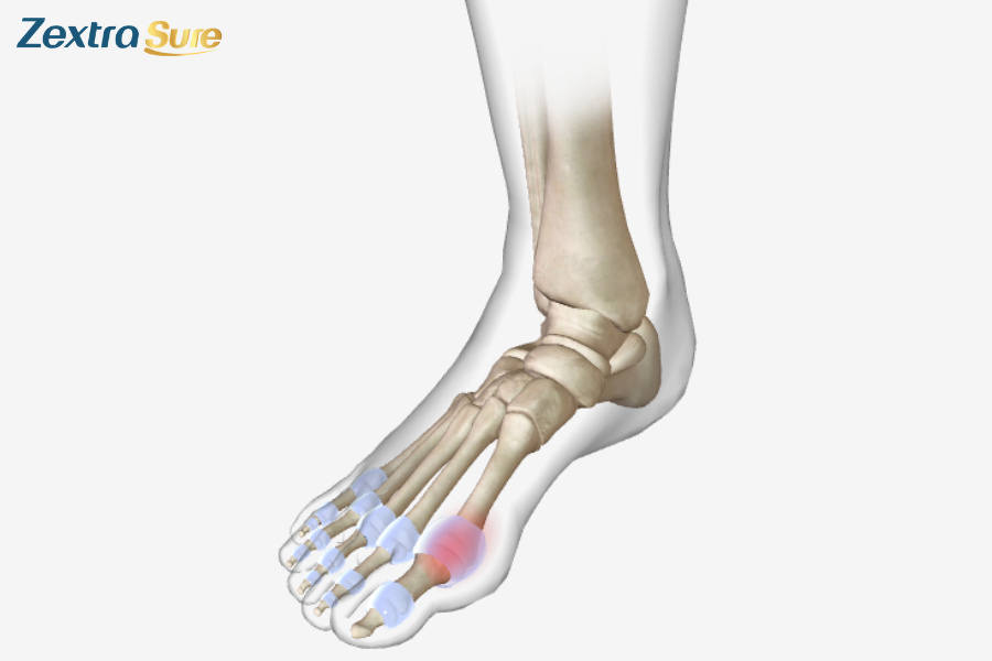 Gout is worse at night because of hormones and circadian rhythm changes